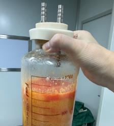 福建水动力吸脂手术要做多久？